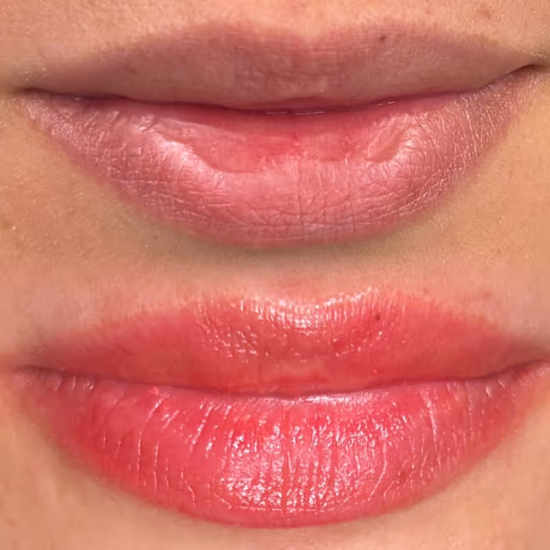 Microneedling Procedure before and after